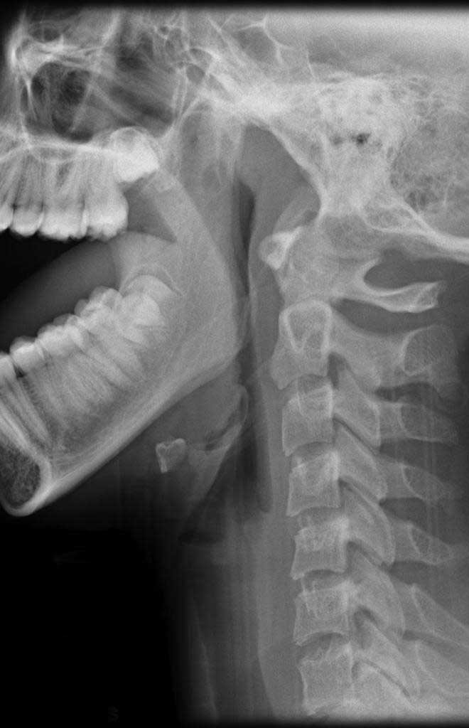 O.P.G. (Orthopantomography
