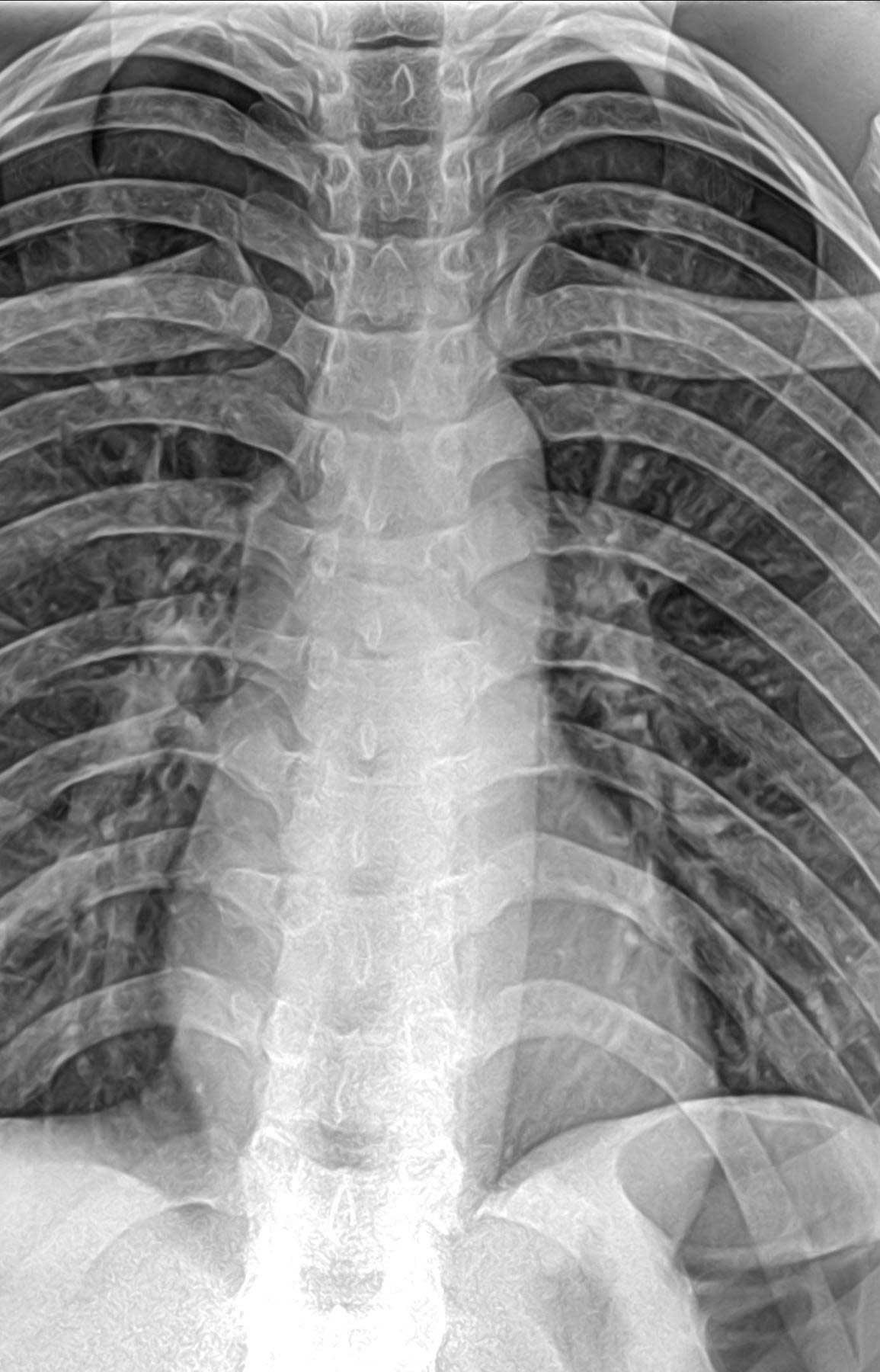 Digital X-ray 